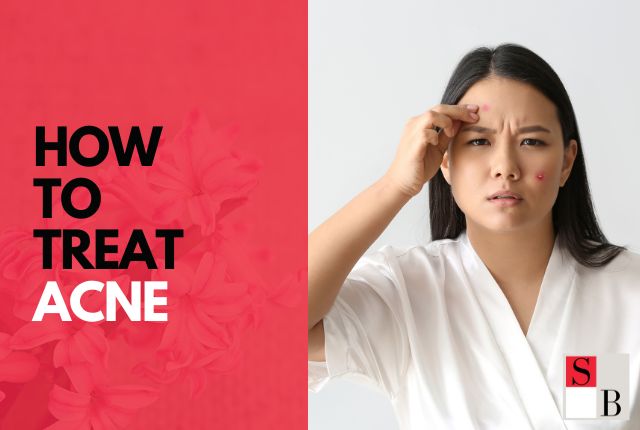 How to Treat Acne: Top Tips for Clear Skin in Singapore