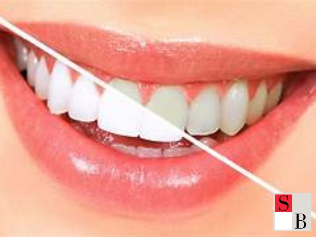 Wellaholic’s TeethWhite: Affordable and Effective Teeth Whitening in Singapore