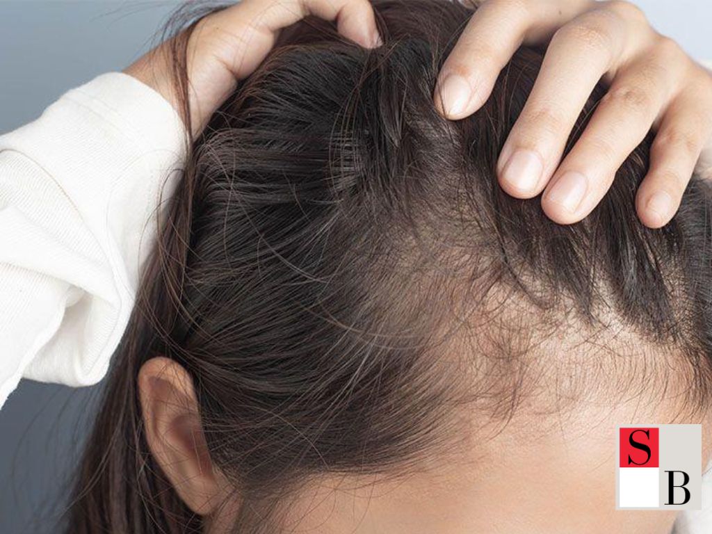 Understanding Alopecia in Asian Hair