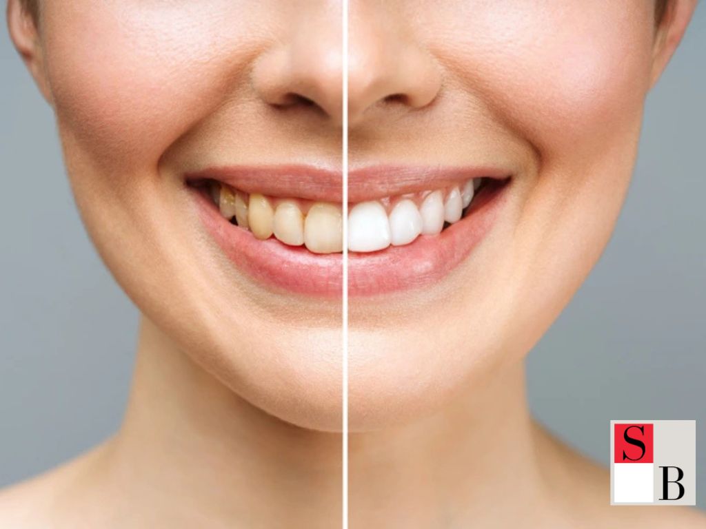 The Benefits of LED Teeth Whitening