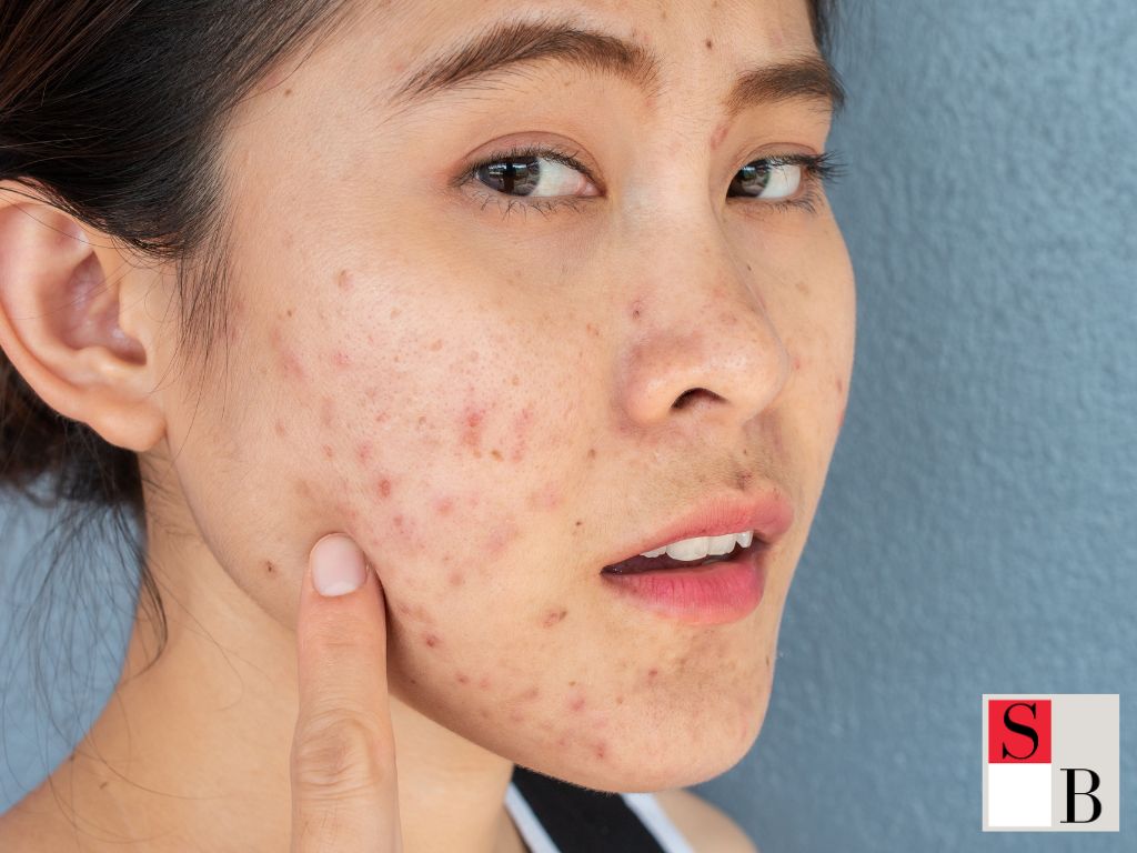 Hormonal imbalances, high humidity, and diet play significant roles in acne development here. The constant moisture can exacerbate oil production, leading to breakouts. An expert dermatologist notes, "Singapore's climate can be particularly challenging for those with acne-prone skin." Addressing these factors with tailored skincare can help mitigate the effects.