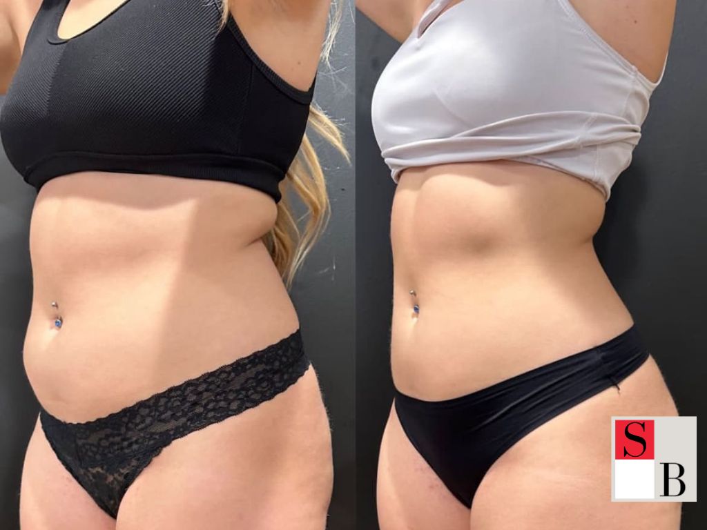 How to Integrate Fat Cavitation into Your Routine in Singapore