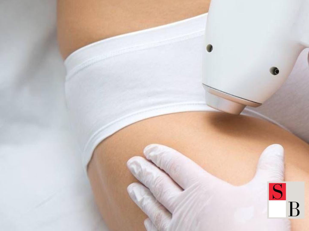 What Is Brazilian Laser Hair Removal? A Game-Changer for Singapore’s Humid Climate