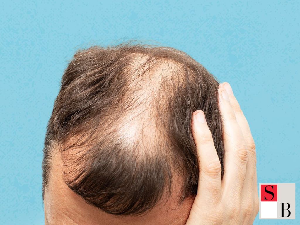 Understanding Alopecia in Singapore’s Climate