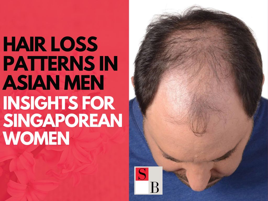Hair Loss Patterns in Asian Men: Insights for Singaporean Women