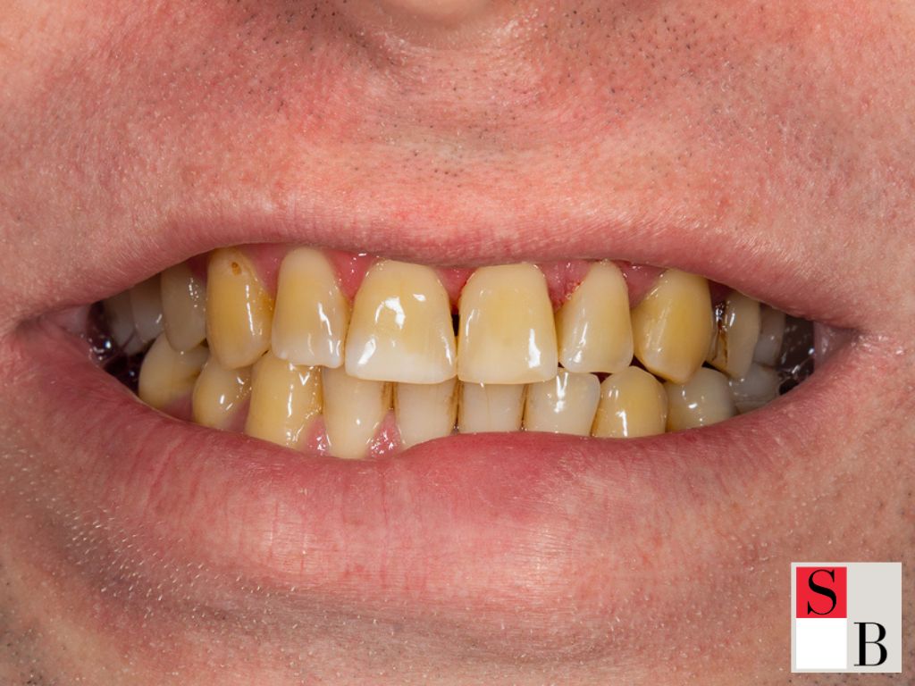 Common Foods That Stain Teeth