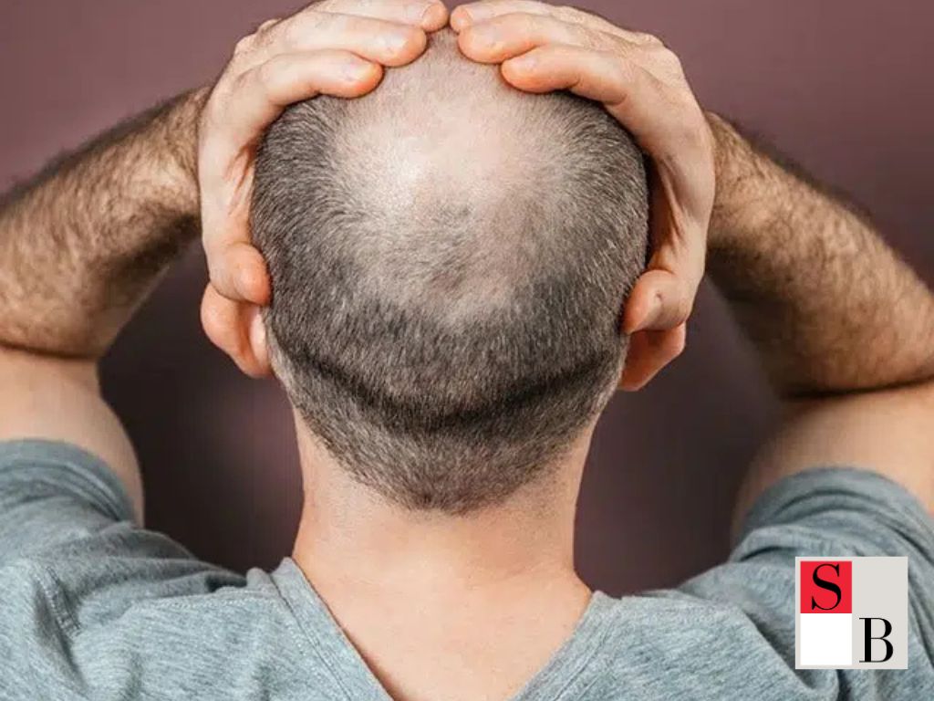 Why Male Hair Loss Matters to Singaporean Women