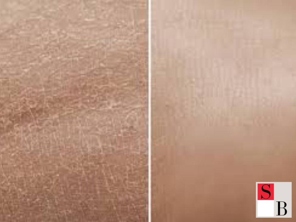 Choosing the Right Hair Removal: SHR or IPL for Your Skin