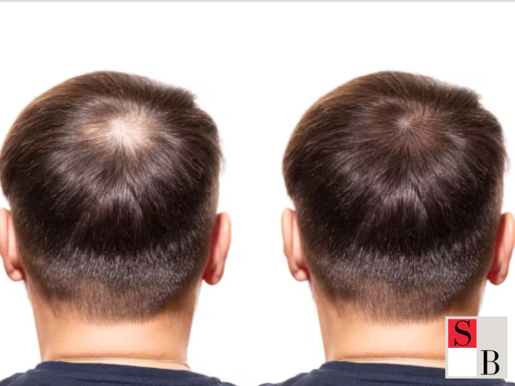 Why Act Early on Hair Loss