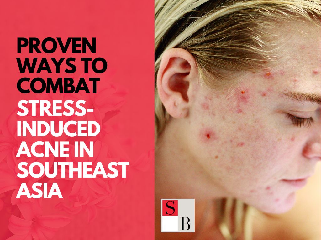 5 Proven Ways to Combat Stress-Induced Acne in Southeast Asia