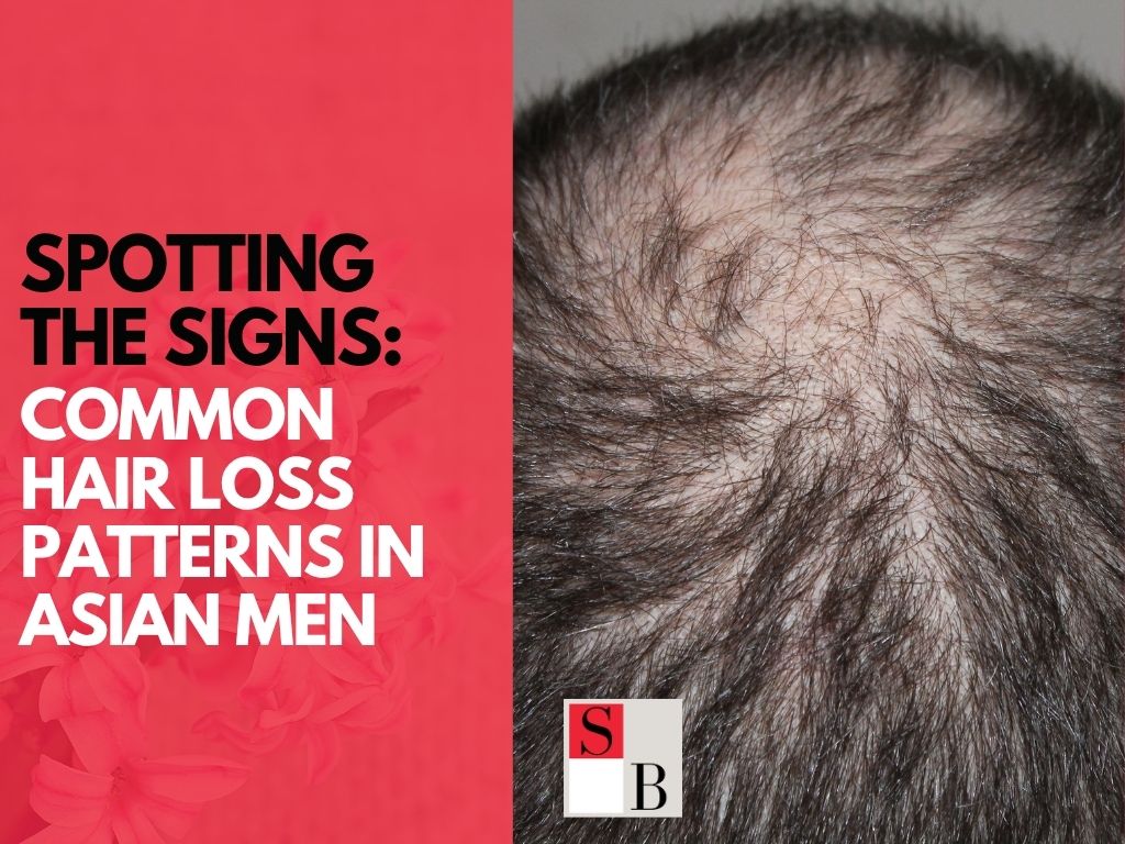Spotting the Signs: Common Hair Loss Patterns in Asian Men