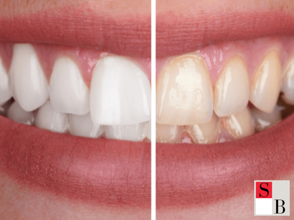 Understanding Teeth Staining: The Science Behind Discoloration