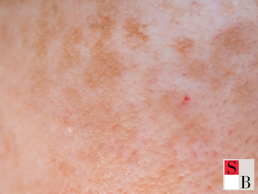 Why Bakuchiol Outshines Retinol for Sensitive Skin