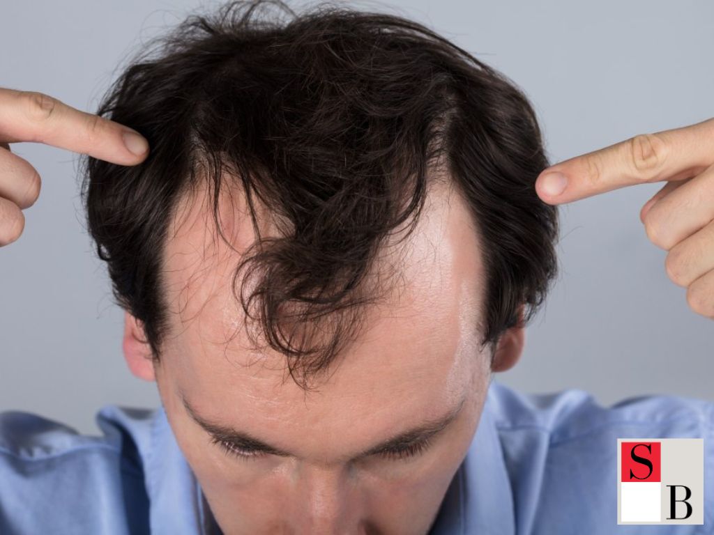 Why Understanding Male Hair Loss Helps Women Support Better