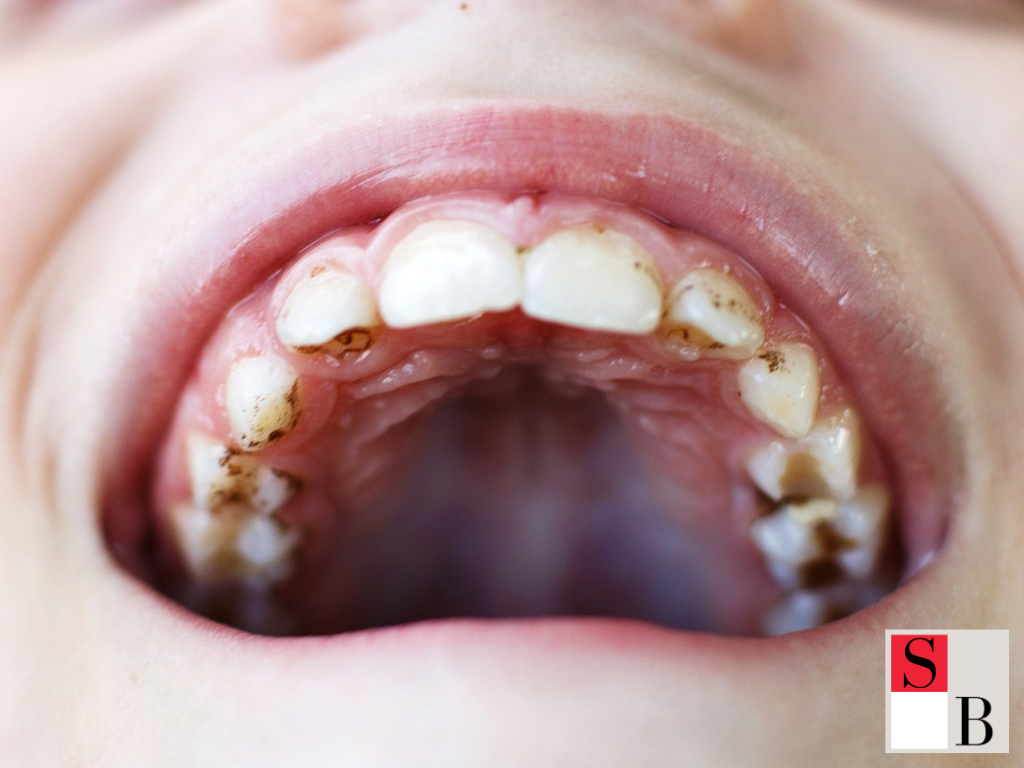 Daily Habits to Prevent Teeth Staining