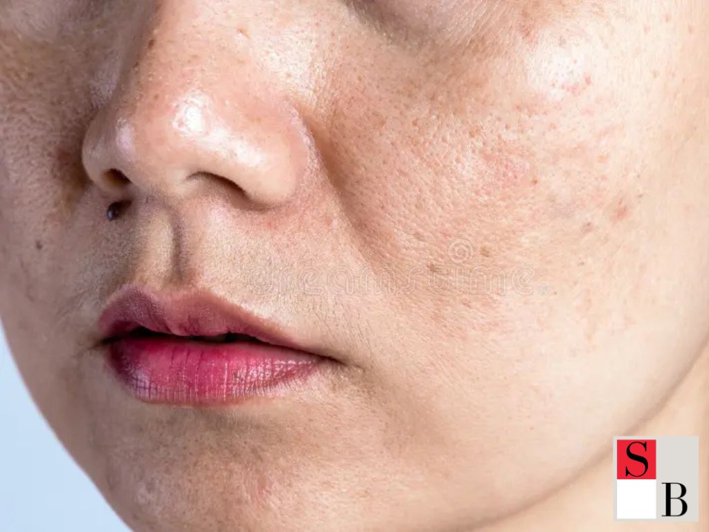 Understanding Hyaluronic Acid in Singapore’s Tropical Climate