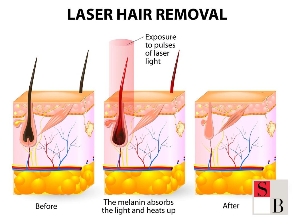 Understanding Hair Removal in Singapore