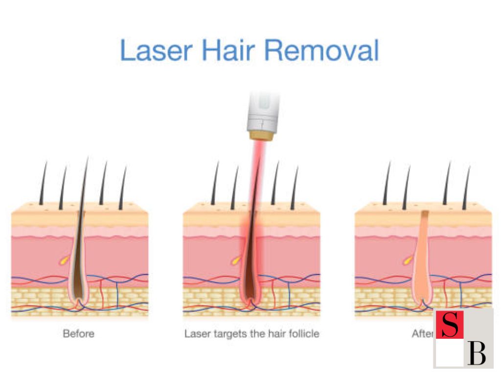 Understanding Hair Removal in Singapore’s Humid Climate