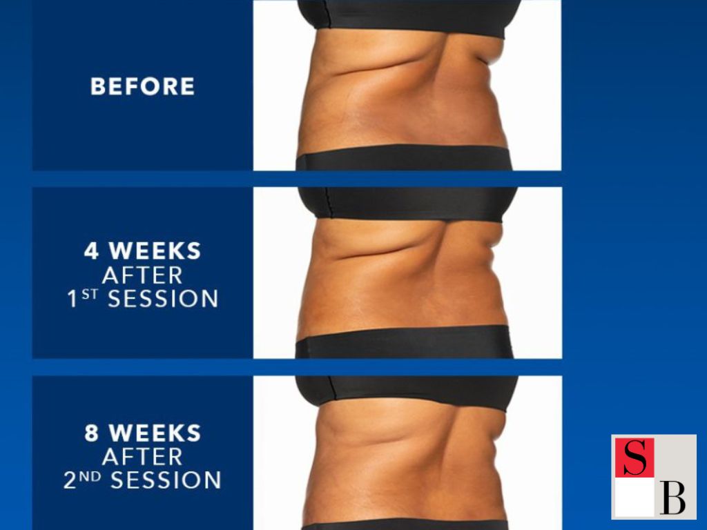What to Expect Before & After Fat-Freezing for Bra Bulge