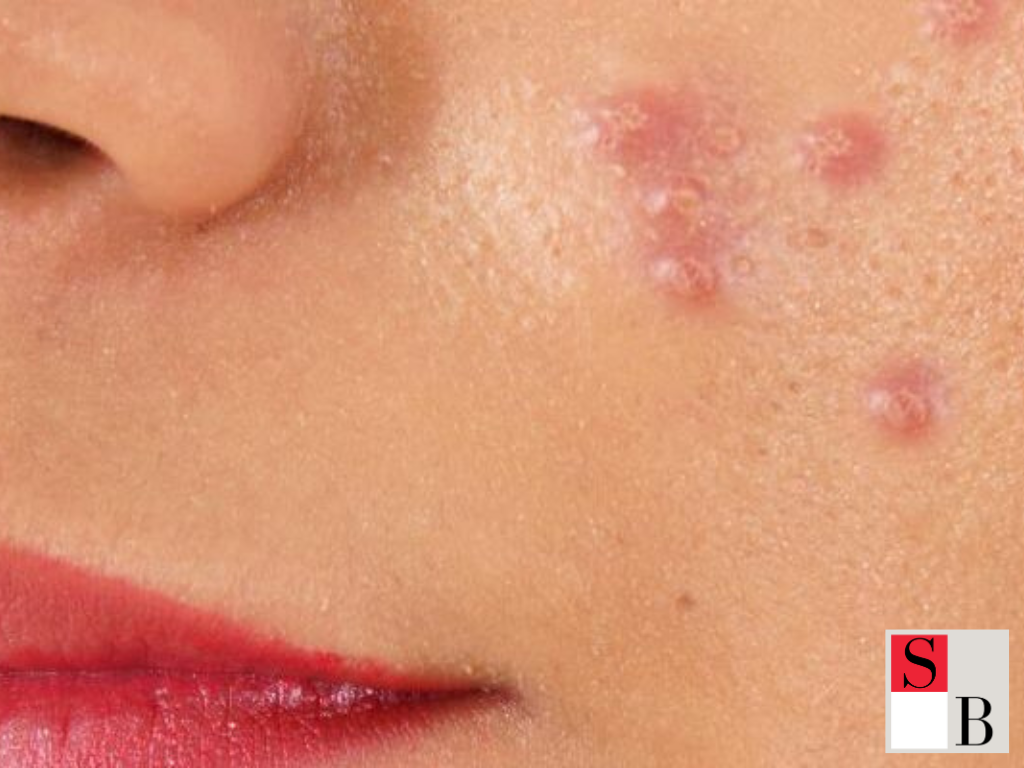 What Causes Acne in Singapore’s Humid Climate
