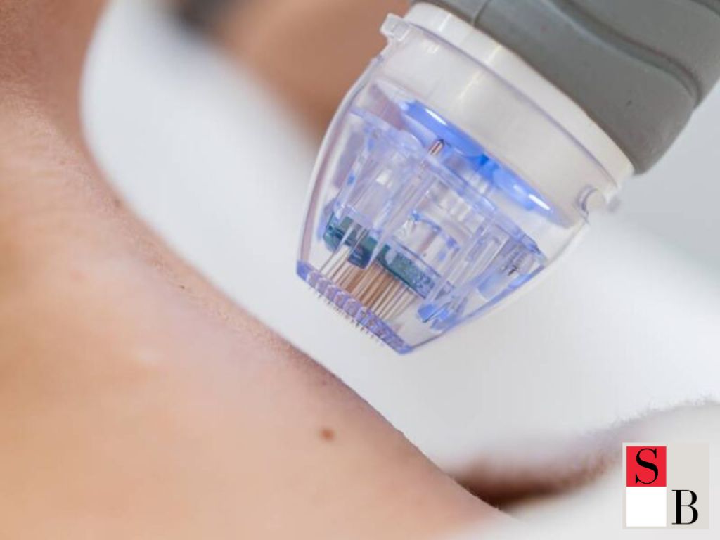 Gold-Plated Microneedling: The Modern Skin Solution for Singapore’s Climate