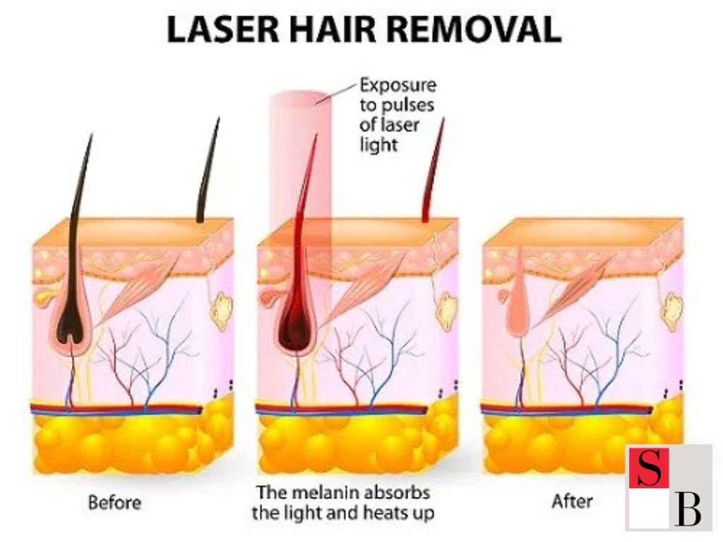 Laser Hair Removal: The Future of Smooth Skin in Singapore