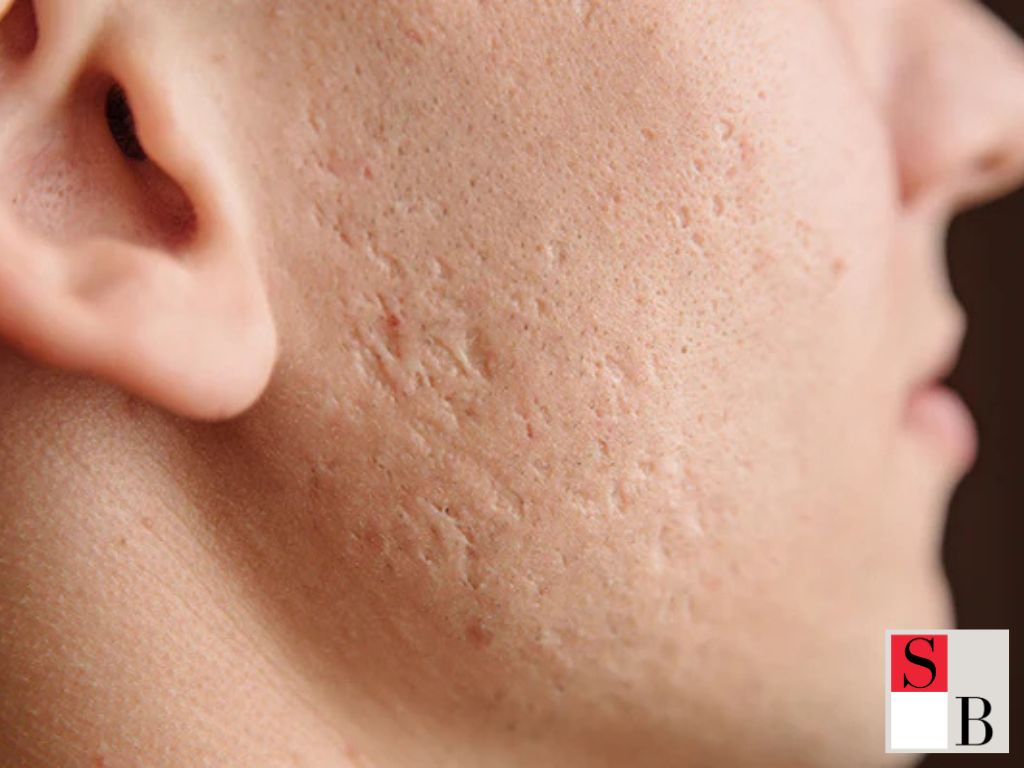 Top Microneedling Benefits for Singaporean Skin