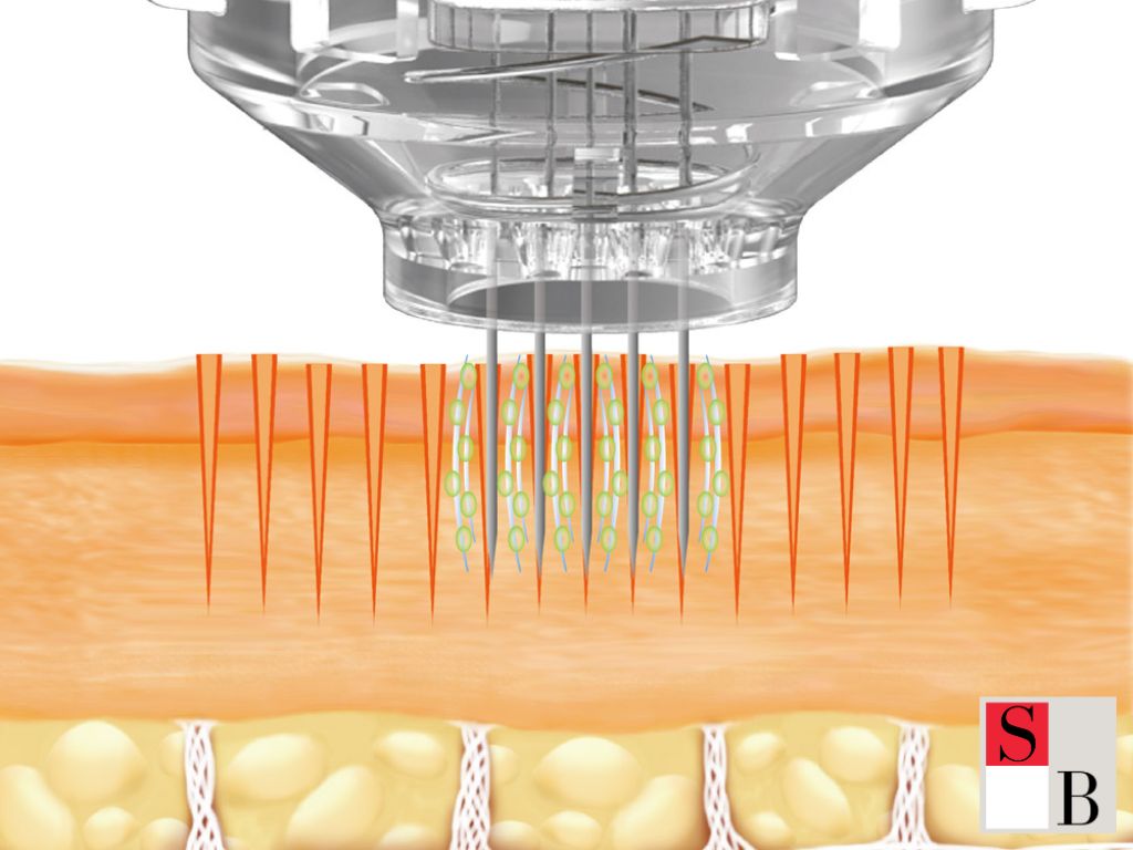 What Is Microneedling and Why It Matters in Singapore