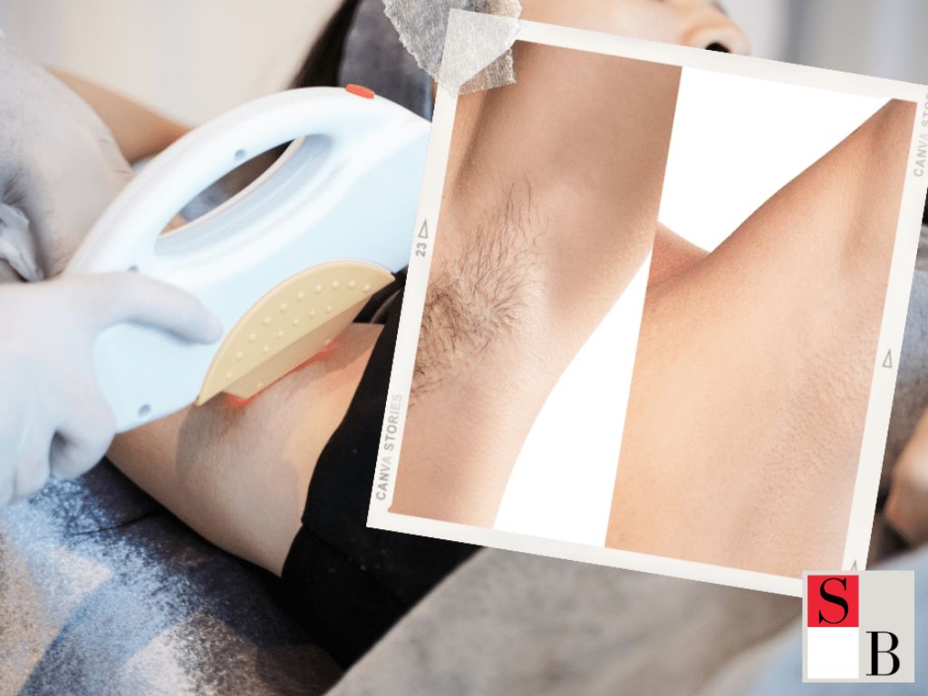 Effective Hair Removal Treatments in Singapore: What You Need to Know