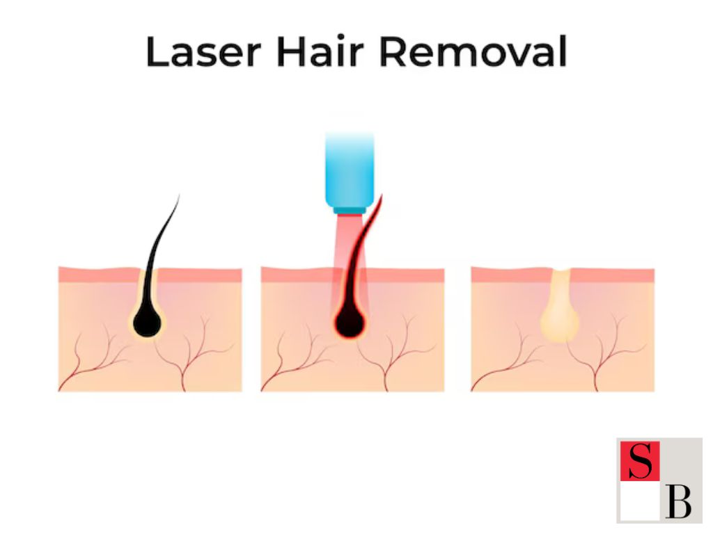 Understanding Modern Hair Removal in Upper Changi