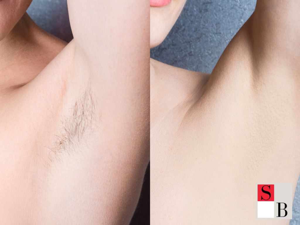 Understanding Permanent Hair Removal in Singapore: What You Need to Know