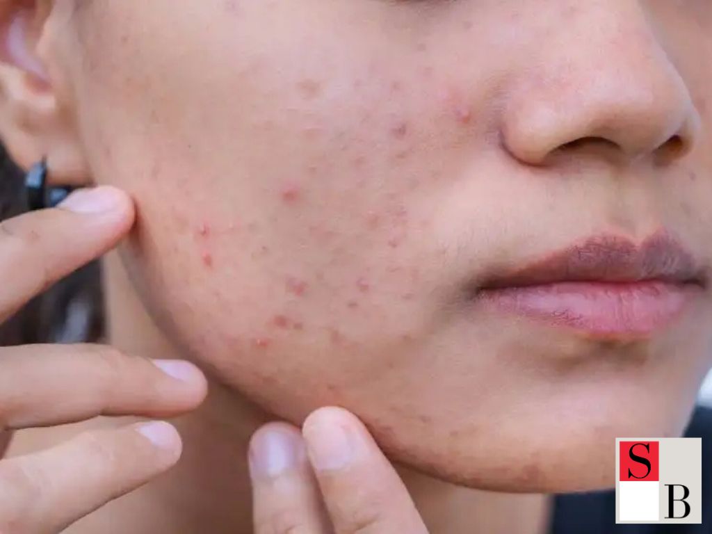 How Stress Triggers Acne A Singapore-Specific Perspective