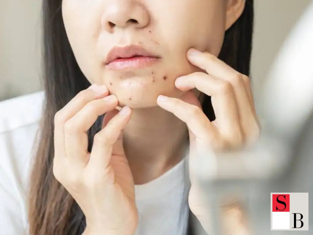 Stress Acne Prevention Lifestyle Changes That Matter