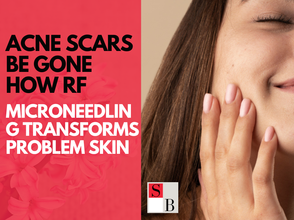 Acne Scars Be Gone: How RF Microneedling Transforms Problem Skin