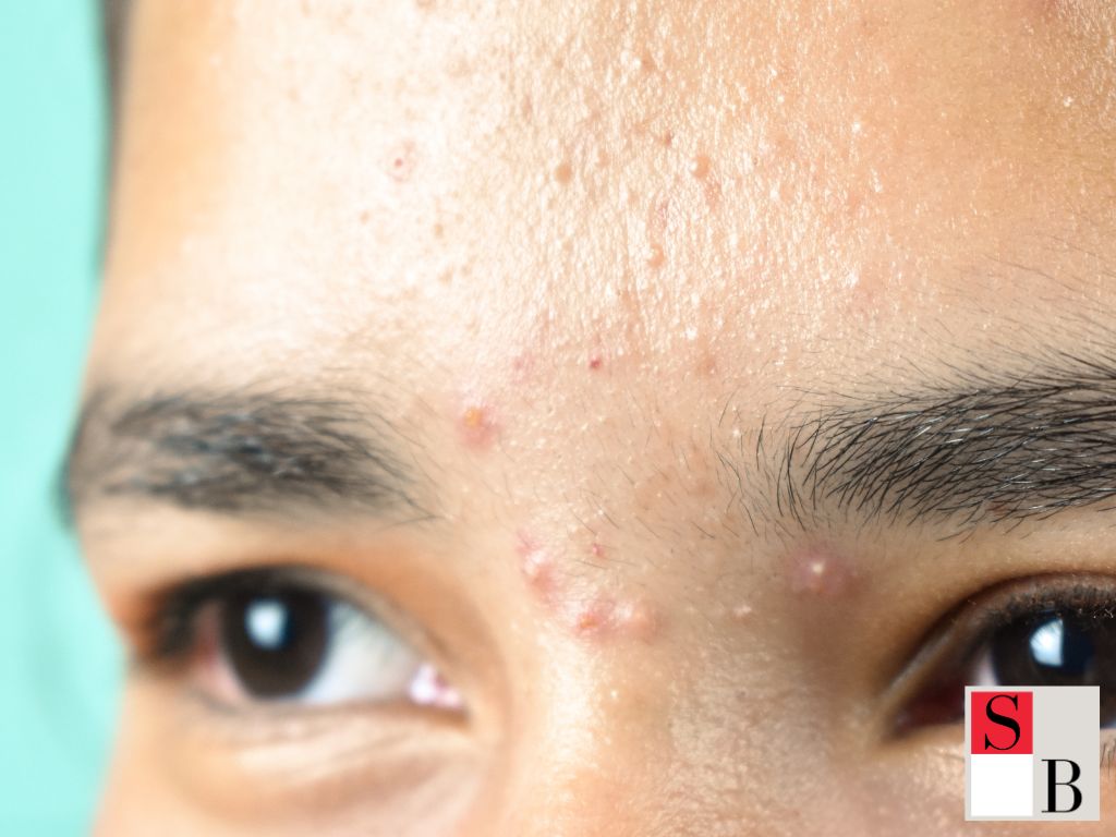Clear Skin Starts with Calm — How Acne Prevention Begins With Stress Management