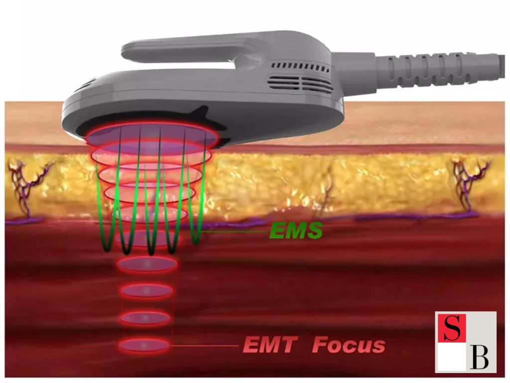 What Is EMS Toning and Why It’s Gaining Popularity in Singapore