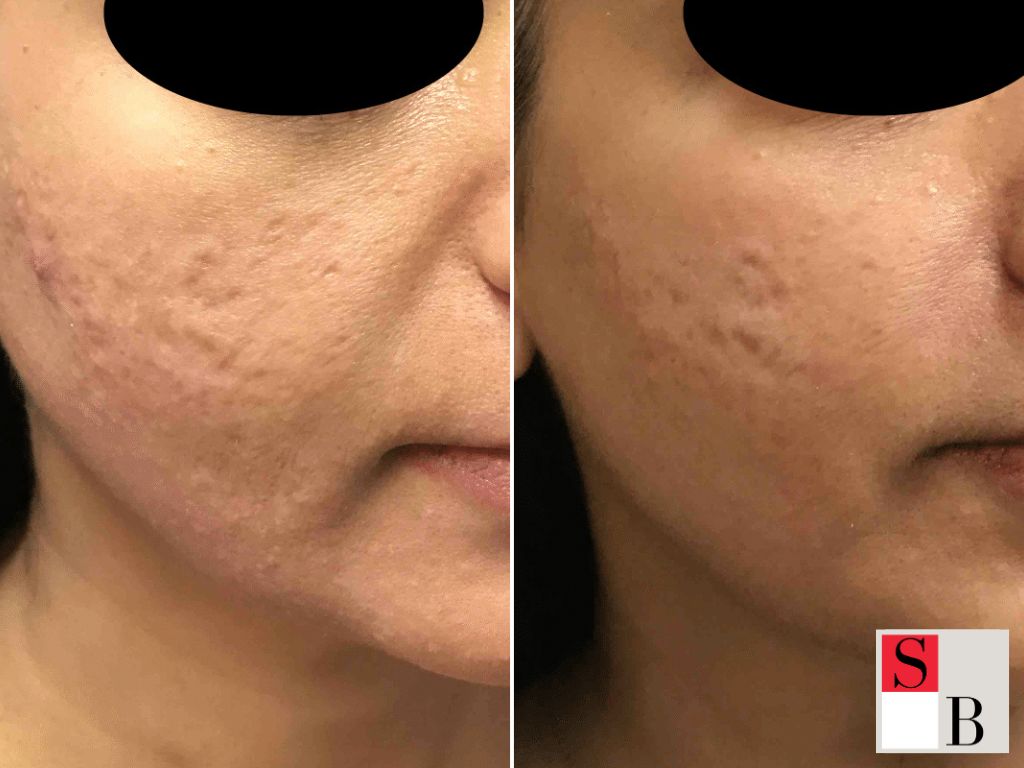 Why RF Microneedling Works Better for Singapore Skin