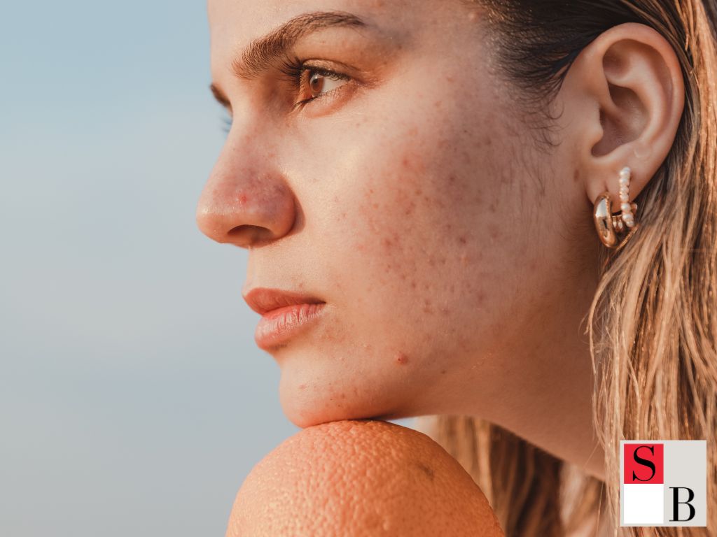 How to Treat Stress Breakouts Effectively—Singapore’s Skincare Playbook