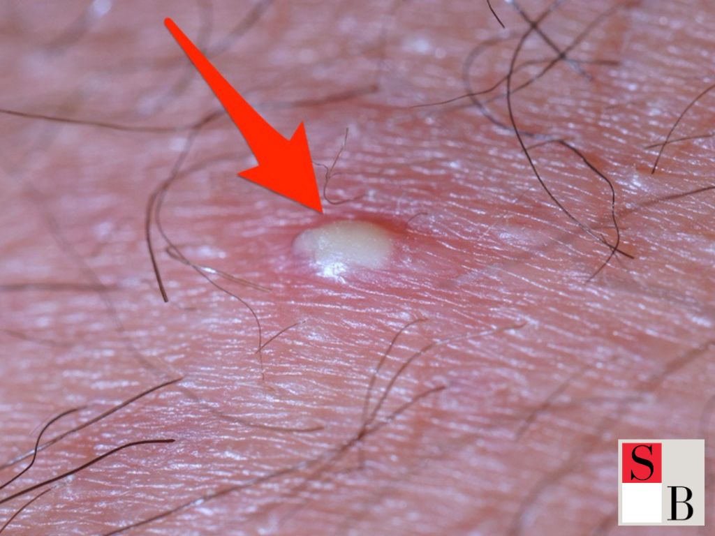 The Key Benefits of Laser Hair Removal in Singapore’s Climate