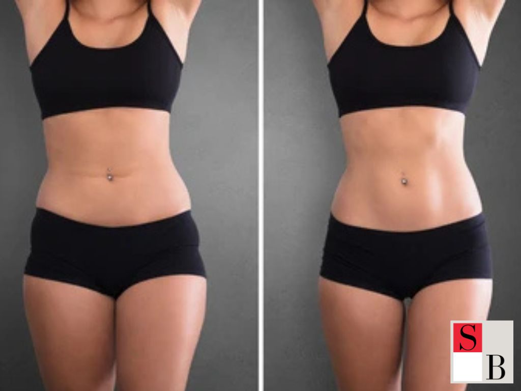 What Is Non-Invasive Body Sculpting in Singapore?