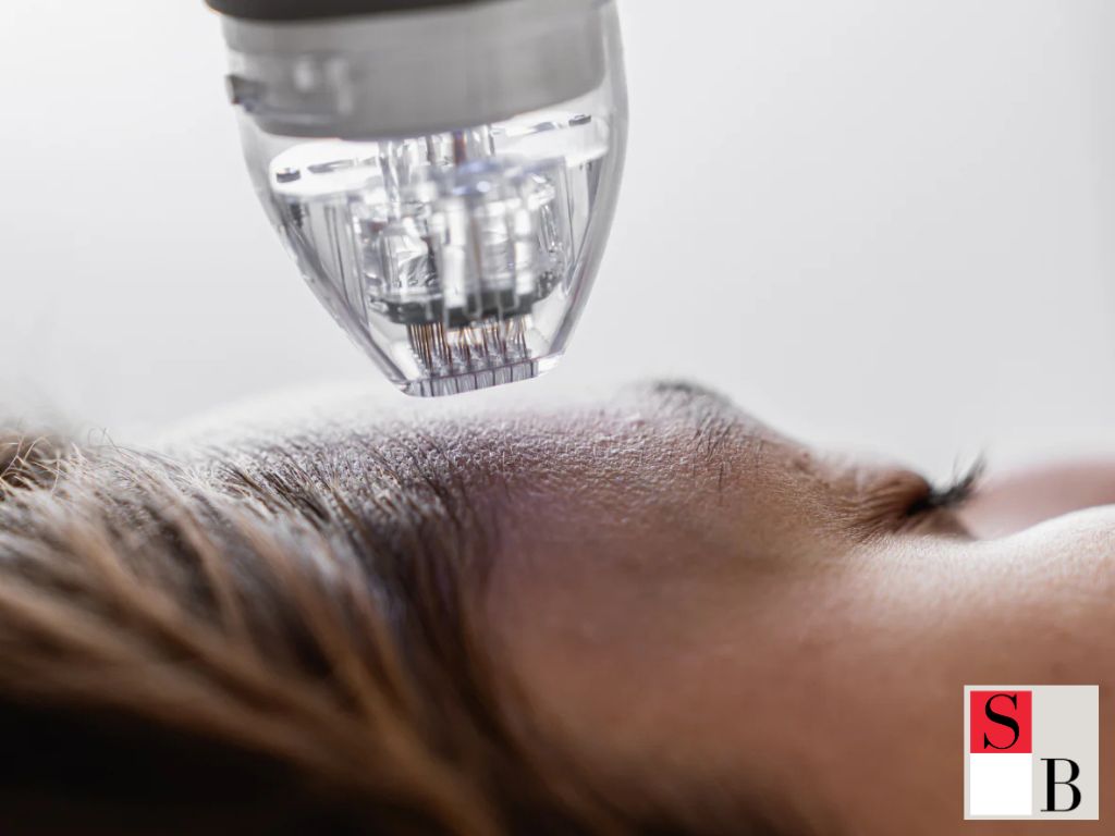 How to Maximise Results from RF Microneedling in Singapore