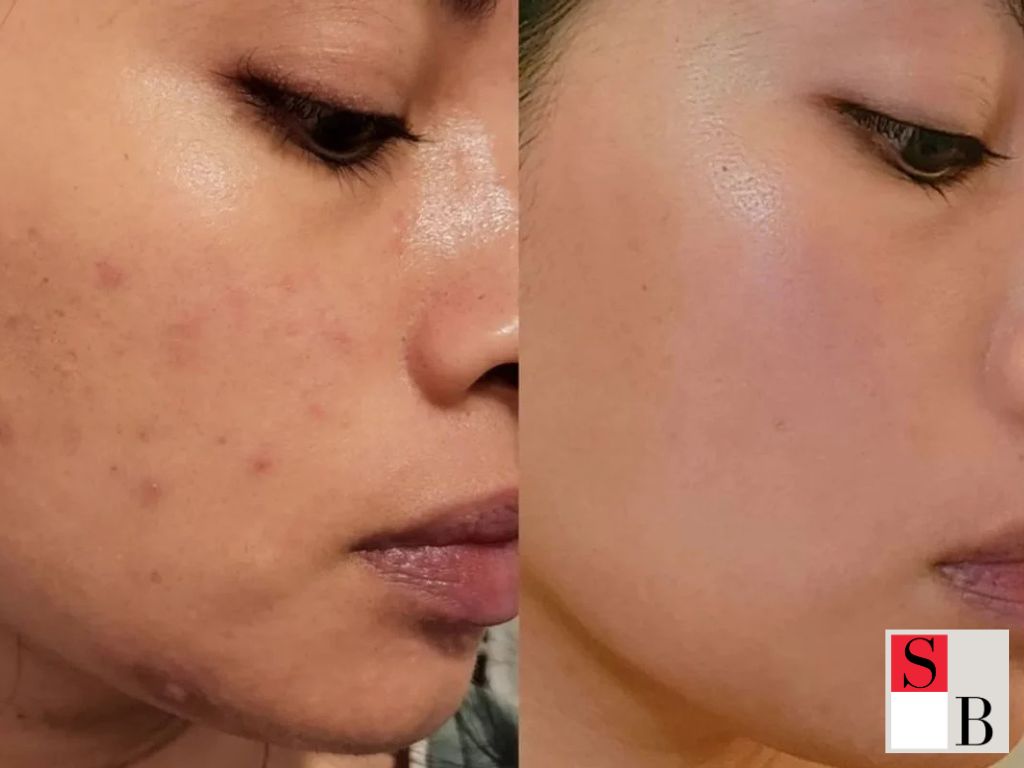Why Microneedling Works for Asian Skin in Singapore