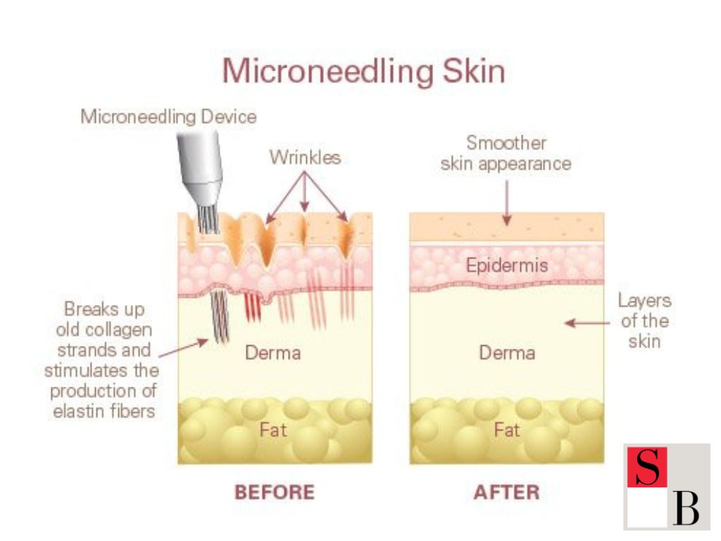 What Is Microneedling and Why It’s Gaining Popularity in Singapore