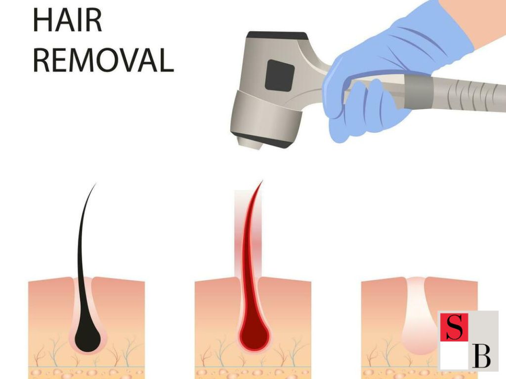 How to Maximise Hair Removal Results in Singapore’s Climate