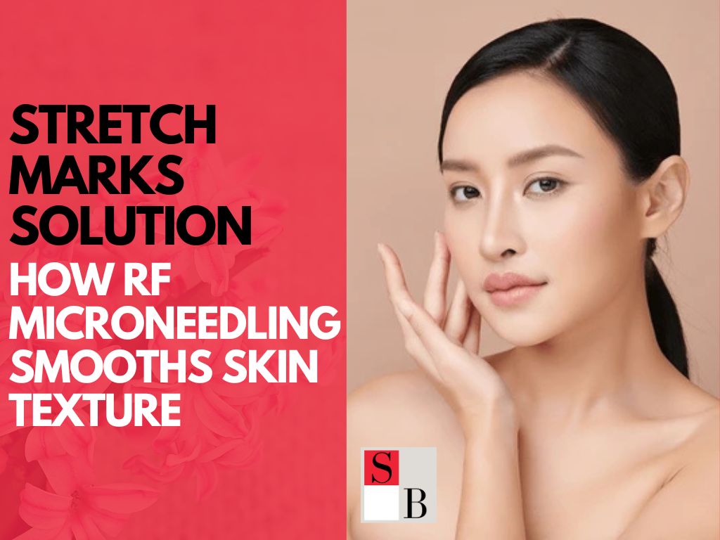 Stretch Marks Solution: How RF Microneedling Smooths Skin Texture