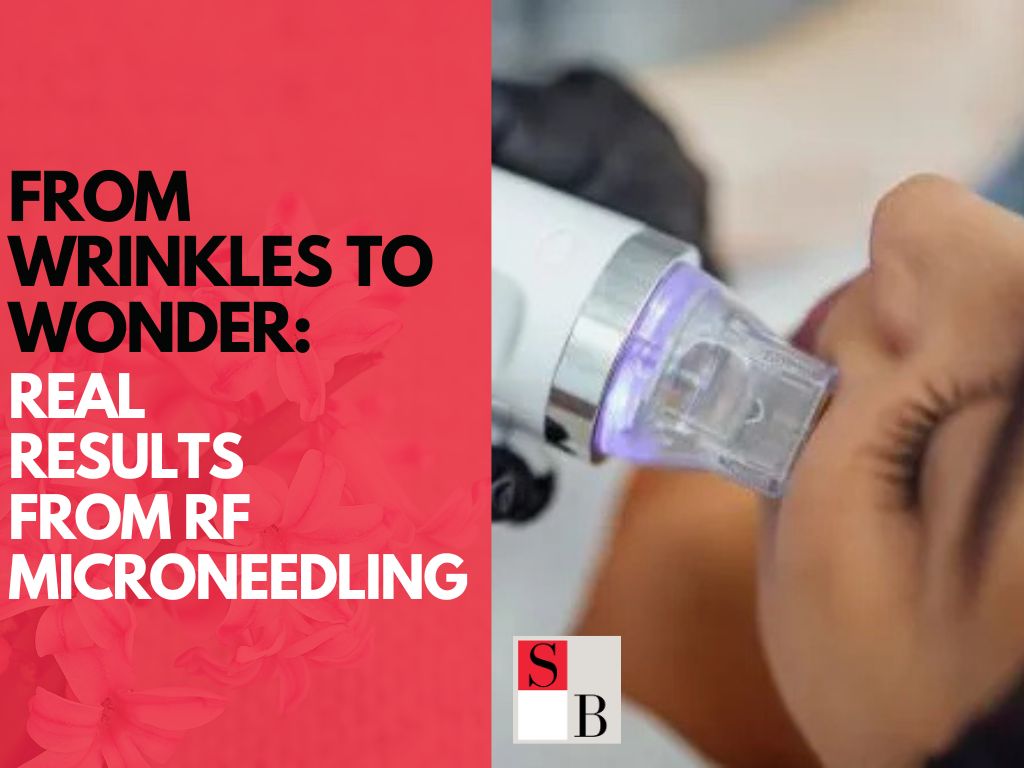 From Wrinkles to Wonder: Real Results from RF Microneedling