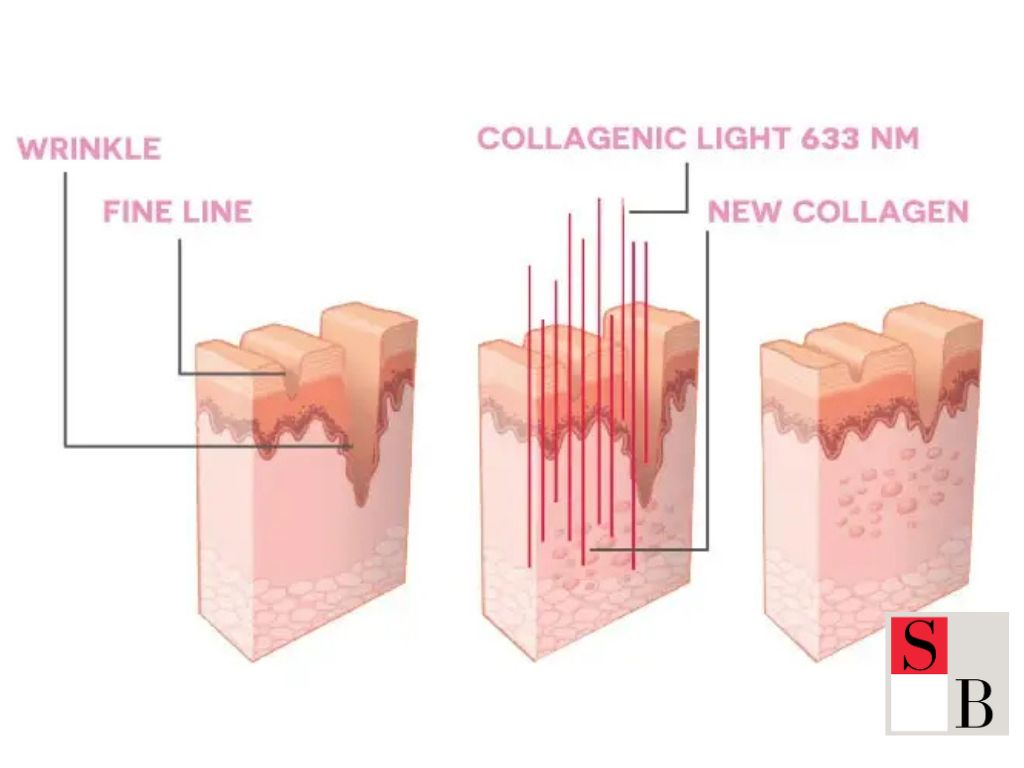 Why Elight is the Game-Changer for Skin in Singapore