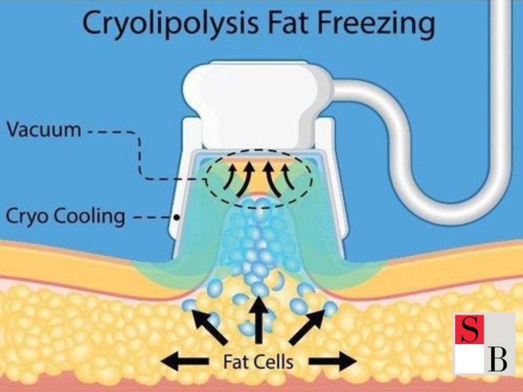 How to Fit Fat Freezing Into a Singaporean Lifestyle