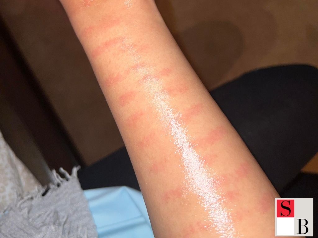 Why Laser Hair Removal Fails in Singapore
