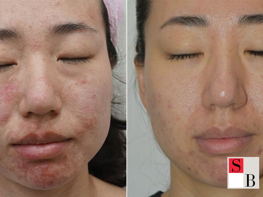 How to Maximize RF Microneedling Results in Singapore
